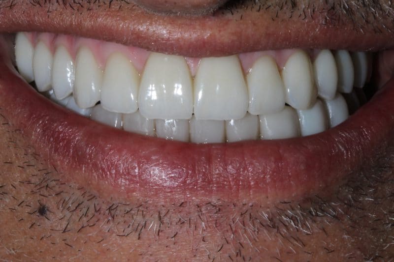 After single tooth implant