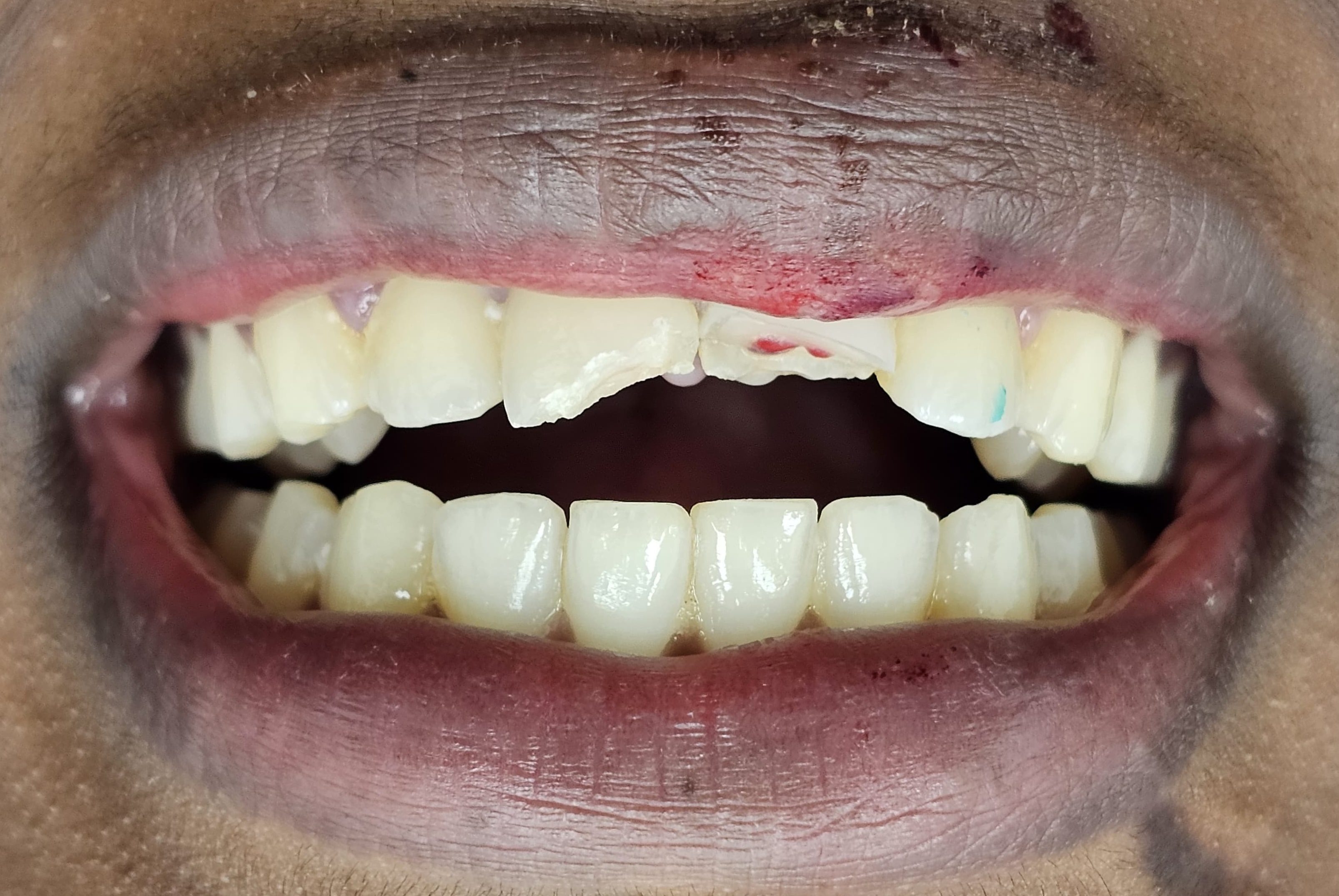 Emergency Tooth Repair before