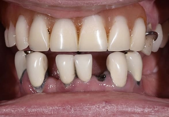 Before multiple implants